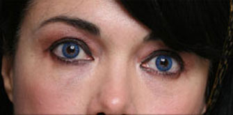 After Lower Eyelid Surgery Los Angeles Dr. Steinsapir
