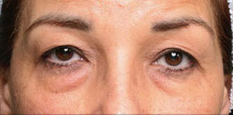 Before Lower Eyelid Surgery Bevelry Hills Dr. Steinsapir