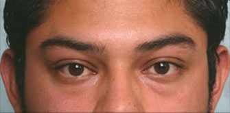 Before Lower Blepharoplasty Los Angeles Dr. Steinsapir