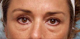 Before Lower Blepharoplasty Beverly Hills Dr. Steinsapir