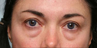 Before Lower Eyelid Surgery Los Angeles Dr. Steinsapir