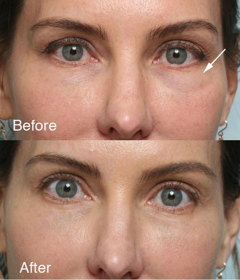 Fixing botched filler before and after