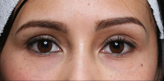 Dark Circles-before-after