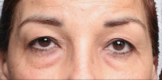 Dark Circles-before-after