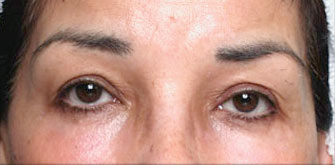 Dark Circles-before-after