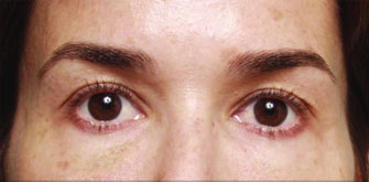 Dark Circles-before-after