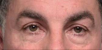 Dark Circles-before-after