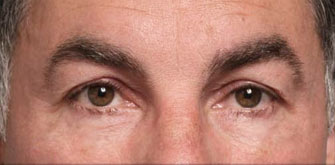 Dark Circles-before-after
