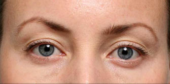 Dark Circles-before-after