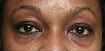 Dark Circles-before-after