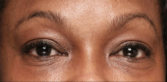 Dark Circles-before-after