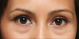 Dark Circles-before-after
