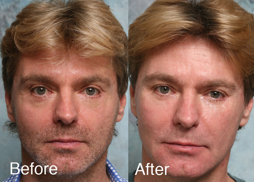 Fixing-lower-eyelid