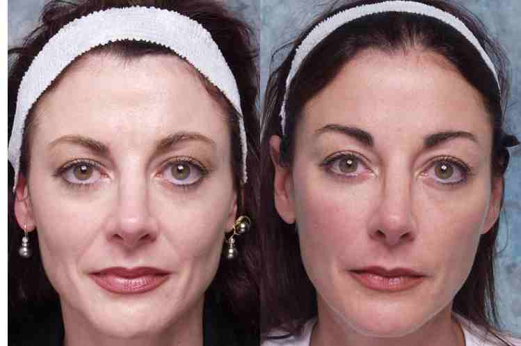 Forehead Lift Benefits