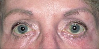 Lower Eyelids Surgery