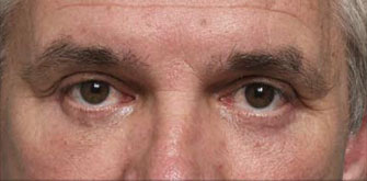 Lower Eyelids Surgery