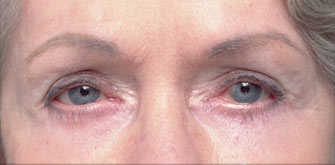 Lower Eyelids Surgery
