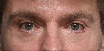 Lower Eyelids Surgery