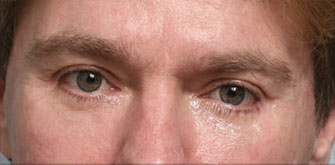 Lower Eyelids Surgery