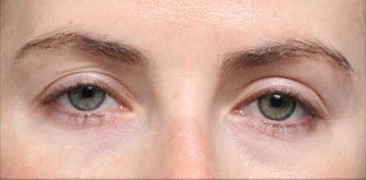 Ptosis-before-after