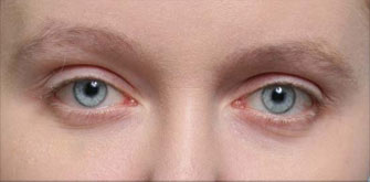 Ptosis-before-after
