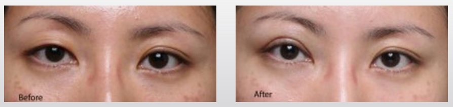before-after-revisional