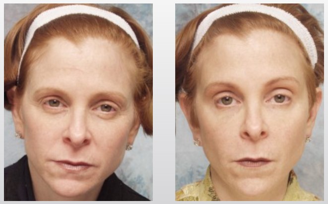 bxd-before-after