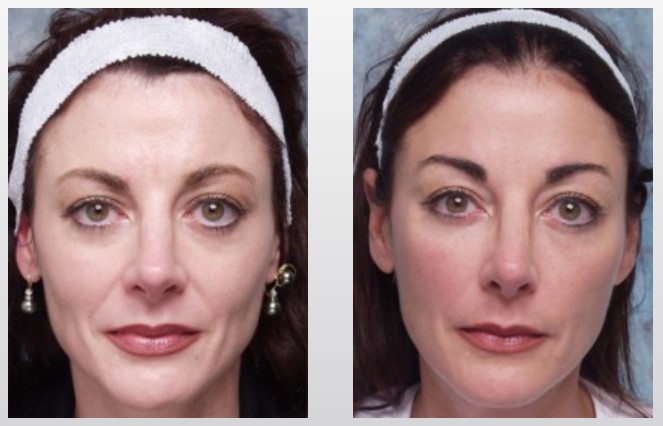 face-before-after-2