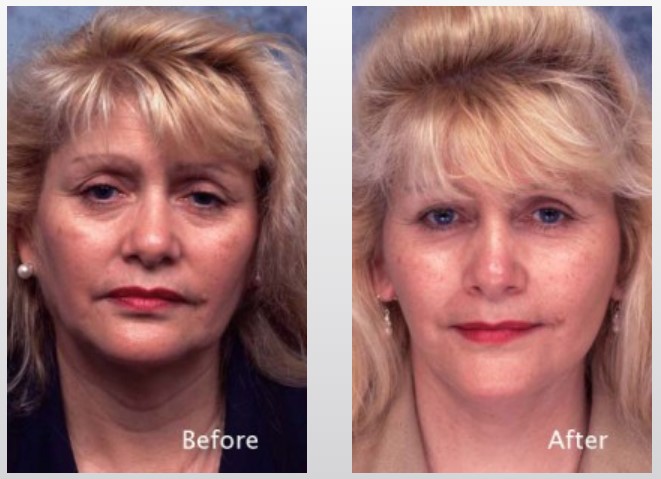 face-before-after