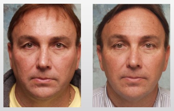 face-neck-lipo