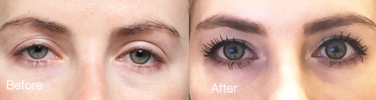 fixed-upper-eyelid-surgery