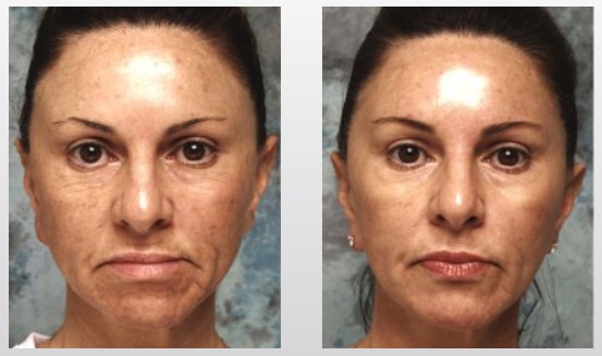 fotofacial
