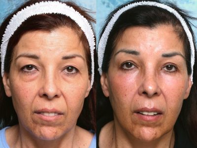 lower-eyelid-surgery