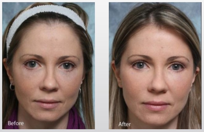 midface-lift