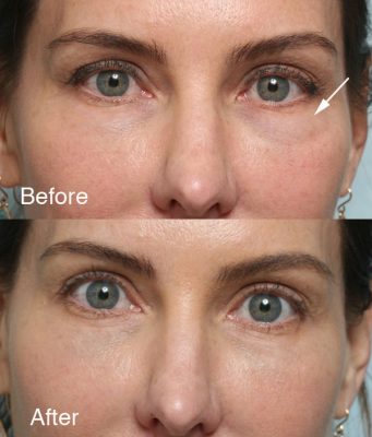 AC-before-and-after