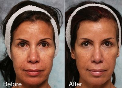 BOTOX