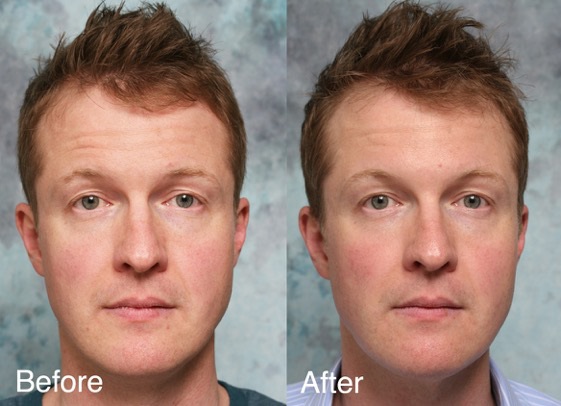 BOTOX