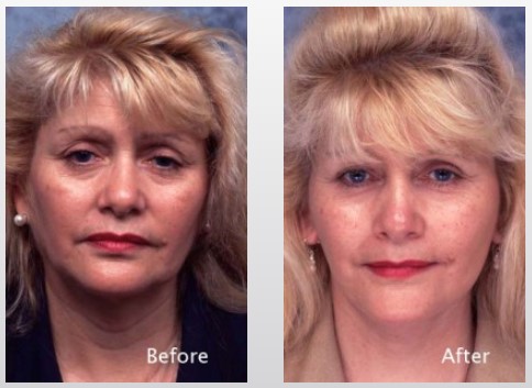 Before-afters