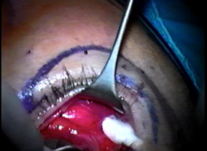 Case #3141