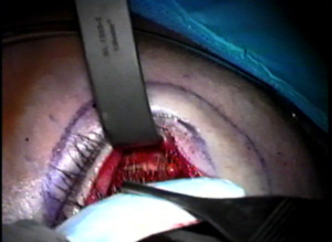 Case #3141
