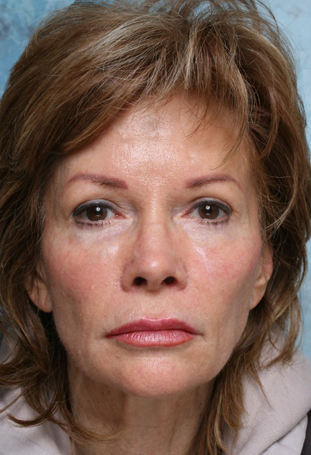 Before Image