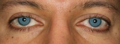 Eye Color Surgery