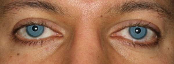 Eye Color Surgery