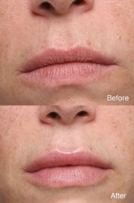 Eyelid Surgery