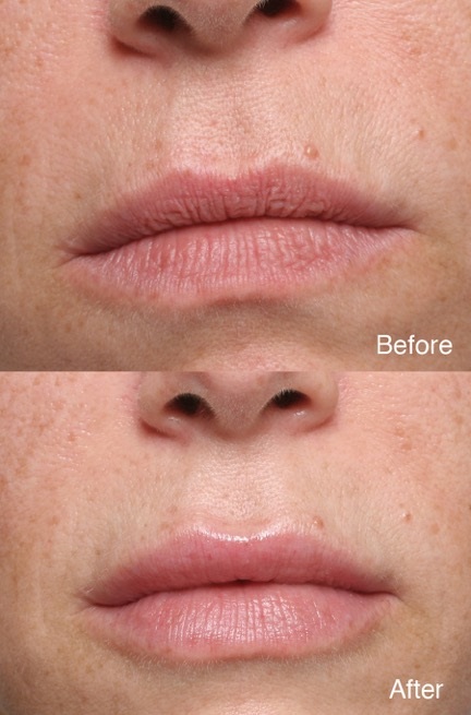Eyelid Surgery