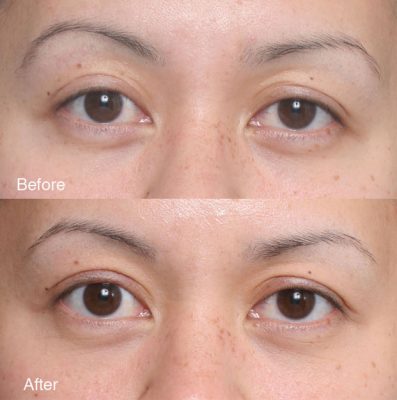 Fixing-upper-eyelids-4