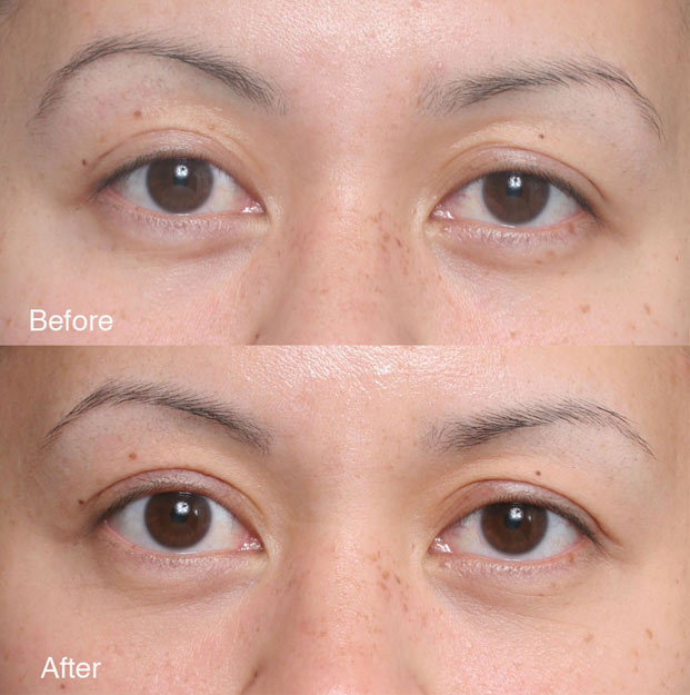 Fixing-upper-eyelids-4