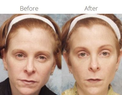 Non-Surgical Procedures