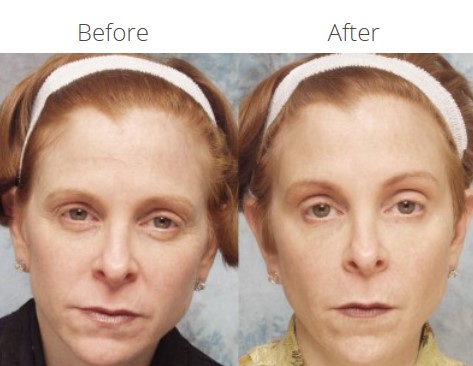 Non-Surgical Procedures