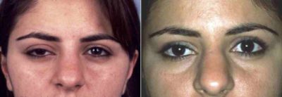 PTOSIS SURGEON